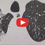 150 millions de nodules pulmonaires en Chine: simple dépistage ou bombe sanitaire cachée ? 150 millions de nodules pulmonaires en Chine simple dépistage ou bombe sanitaire cachée