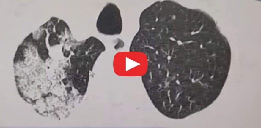 150 millions de nodules pulmonaires en Chine: simple dépistage ou bombe sanitaire cachée ?